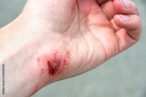 Red wound on the palm, arm, wrist after a burn or fall. First aid in wound treatment. Treatment of wounds. Extreme close up of a red skin burn