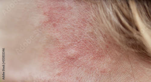 Obraz na plátně Bite mark, sting or sore on human skin
