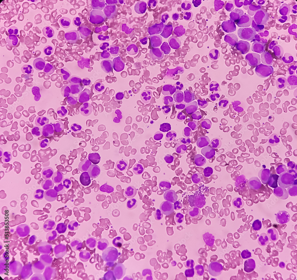 Microscopic image showing Chronic myeloid leukaemia (CML) is a type of