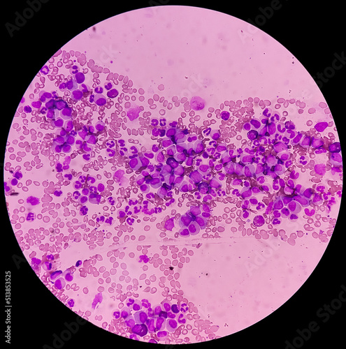 Microscopic image showing Chronic myeloid leukaemia (CML) is a type of cancer, all stage of granulocytic maturation is noted, CML in chronic phase. photo