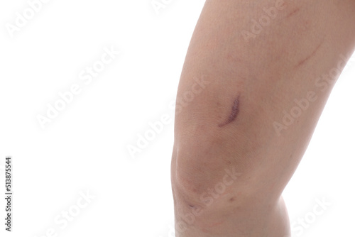 Scar on skin (Keloid or Hipertrophic scar). Close up scar and keloid on legs of woman on white background. concepts of health care and beauty.