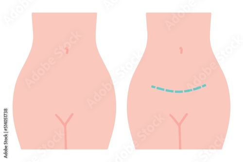 Gynecological surgery, problem with reproductive system.