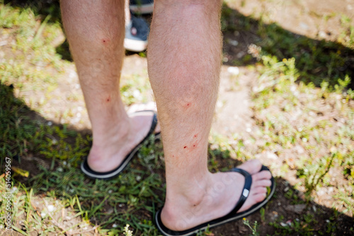 Red dots on human legs, bites of small blood-sucking insects, damage to the skin, itching and irritation of blisters, midge bite, pain in the legs. photo