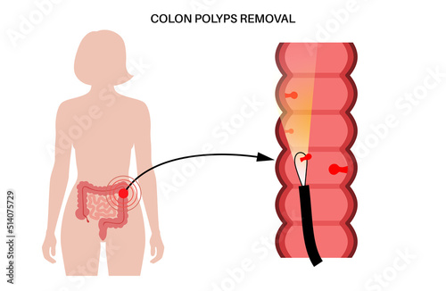 Colon polyps inflammation