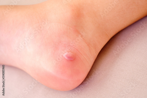 blister on the heel of a girl