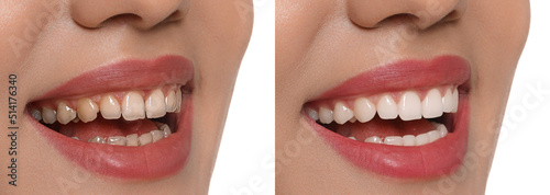 Collage with photos of young woman before and after dental treatment on white background  closeup. Banner design
