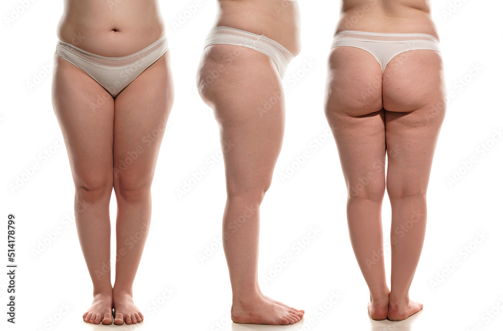 Side leg cellulite sale