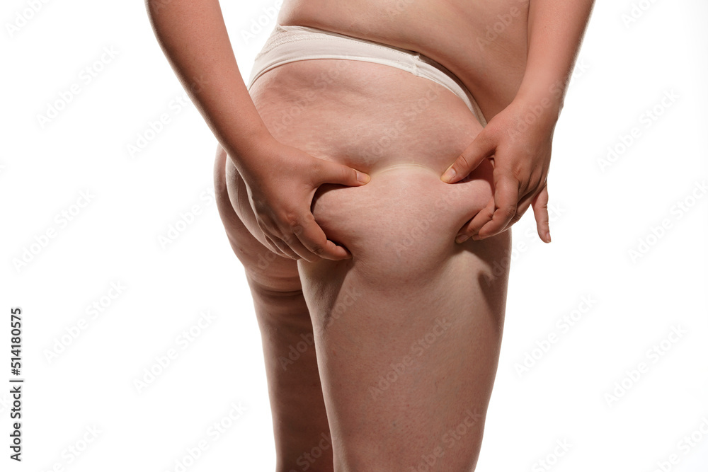 Φωτογραφία Overweight woman showing fat cellulite legs and buttocks, obesity female body is