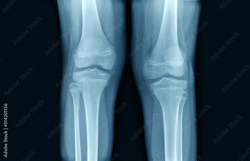 knee joint x ray in blue tone knee joint x ray in blue tone