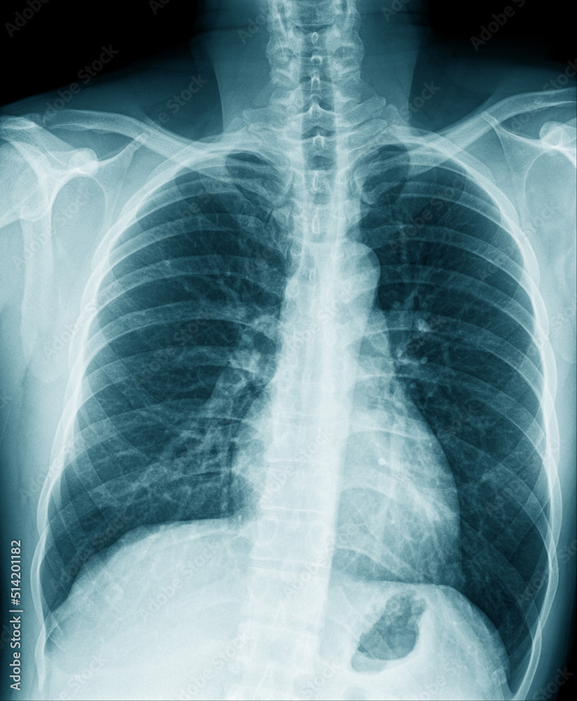 chest x-ray image in blue tone Stock Photo | Adobe Stock