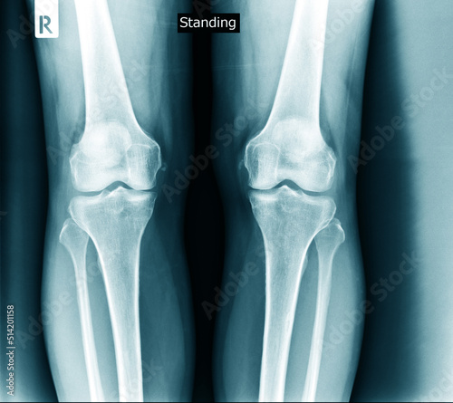 Fotografiet knee joint x ray degeneration