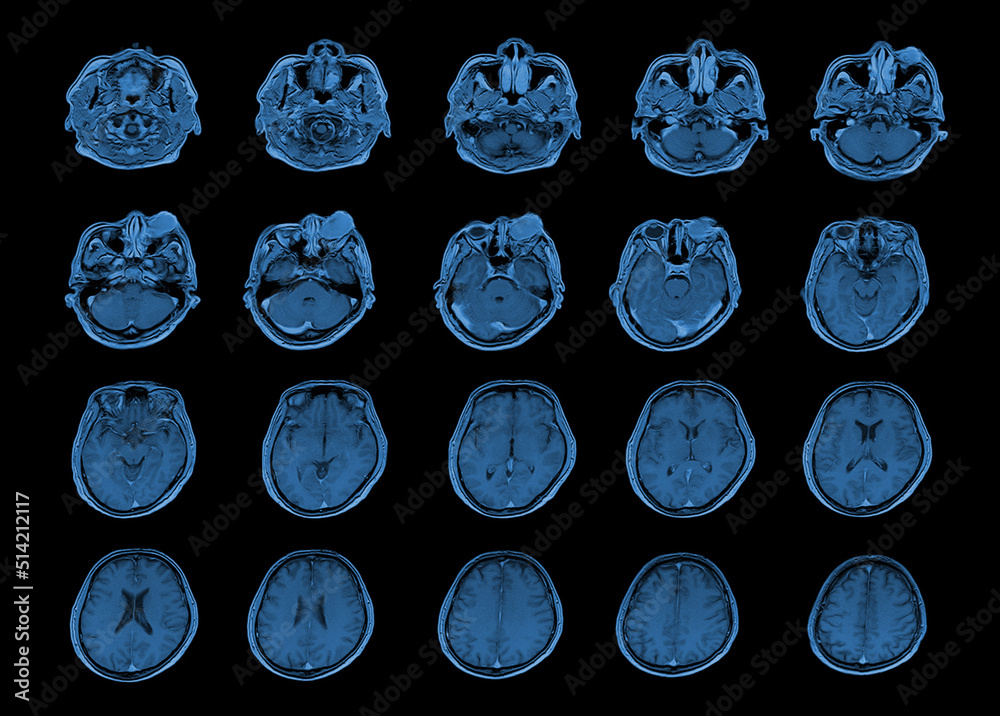 Foto de MRI OF BRAIN AND ORBIT Finding A well-defined, cystic lesion ...
