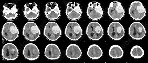 CT Brain History Headache Finding a 7 cm. extra-axial mass with stong enhancement and mass effect to left cerebral hemisphere,meningioma,Medical image concept.