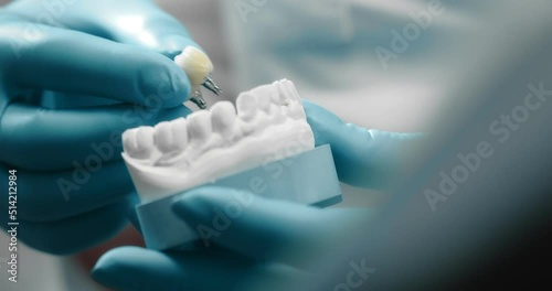 Hands of a dentist dental technician in medical gloves place a dental implant in a plaster model of teeth in a dental laboratory. 