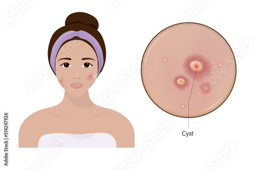 Woman with acne and a close up enlarged image of the facial skin showing cystics.