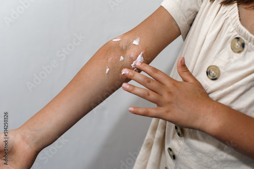 Φωτογραφία Children's atopic skin, moisturizing the skin with emollient cream, atopic derma