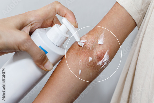 Children's atopic skin, moisturizing the skin with emollient cream, atopic dermatitis photo