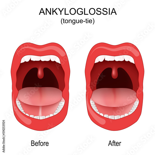 Ankyloglossia. tongue-tie. congenital oral anomaly
