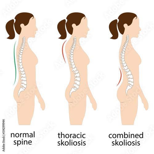 Spine deformation types and healthy spine comparison diagram poster with backbone curvatures. Female profile and back view. Chiropractic information