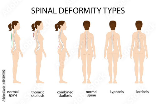 Spine deformation types and healthy spine comparison diagram poster with backbone curvatures. Female profile and back view. Chiropractic information