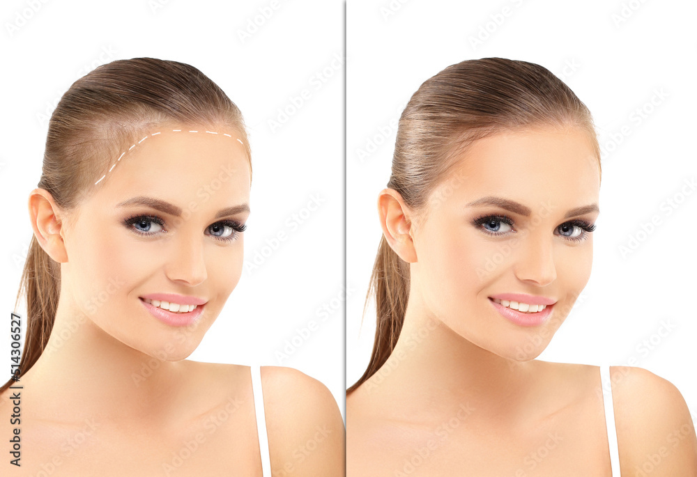 Thinning hair and hair loss,female pattern baldness,Hair transplant Thinning hair and hair loss,female pattern baldness,Hair transplant