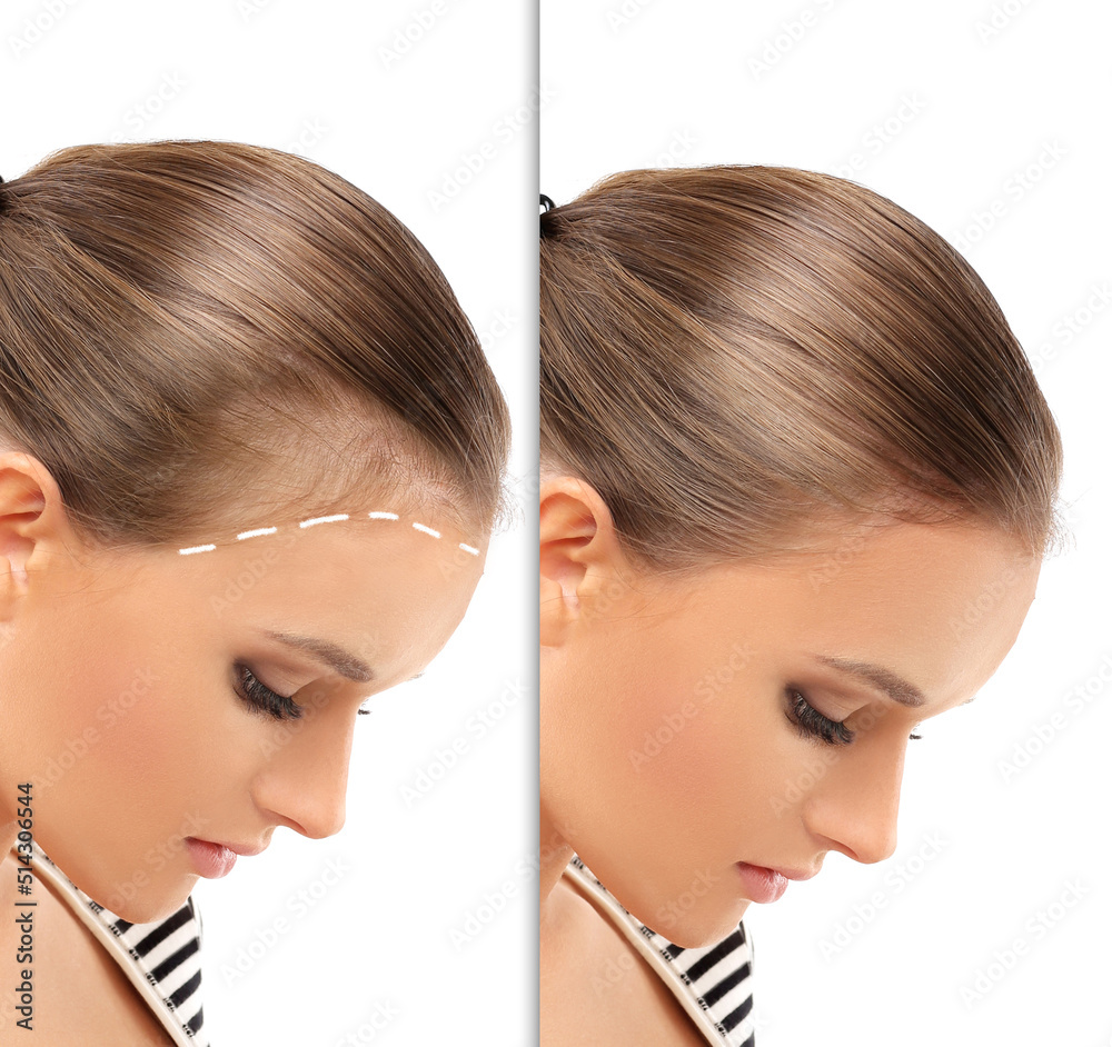 Thinning hair and hair loss,female pattern baldness,Hair transplant Thinning hair and hair loss,female pattern baldness,Hair transplant
