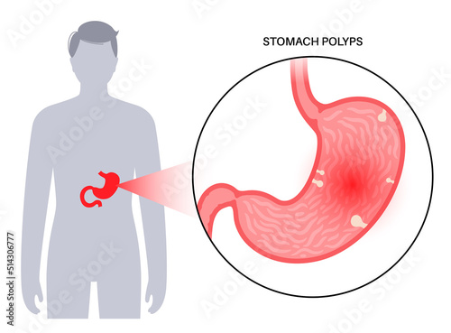 Stomach polyp disease