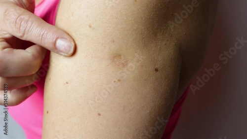A scar from a smallpox vaccination is visible on an mature woman upper arm photo