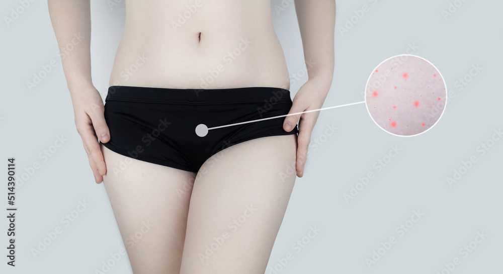 Irritation of the skin of the bikini area. consequences of depilation. Skin injuries. Pimples