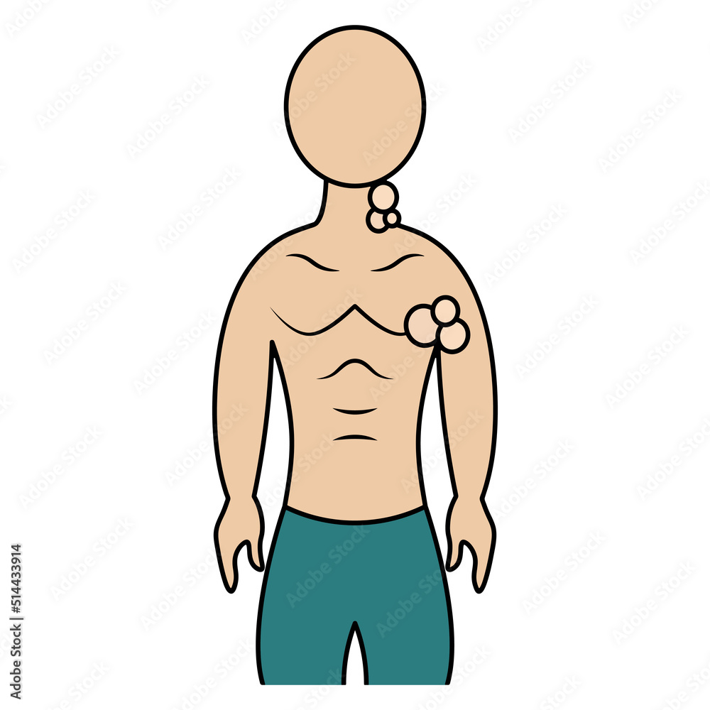 Fototapeta premium Enlarged lymph nodes. Color vector illustration. The patient has inflamed lymph nodes in the neck and armpits. A symptom of a disorder in the body. Isolated background. Cartoon style. Medical theme. 