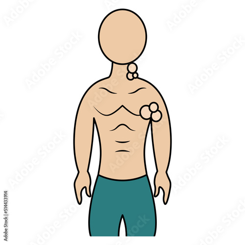 Enlarged lymph nodes. Color vector illustration. The patient has inflamed lymph nodes in the neck and armpits. A symptom of a disorder in the body. Isolated background. Cartoon style. Medical theme. 