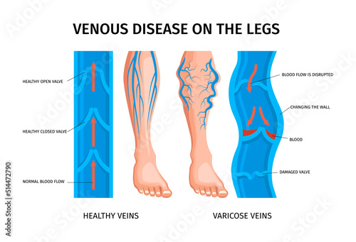 Venous Disease Of Legs Infographics Poster