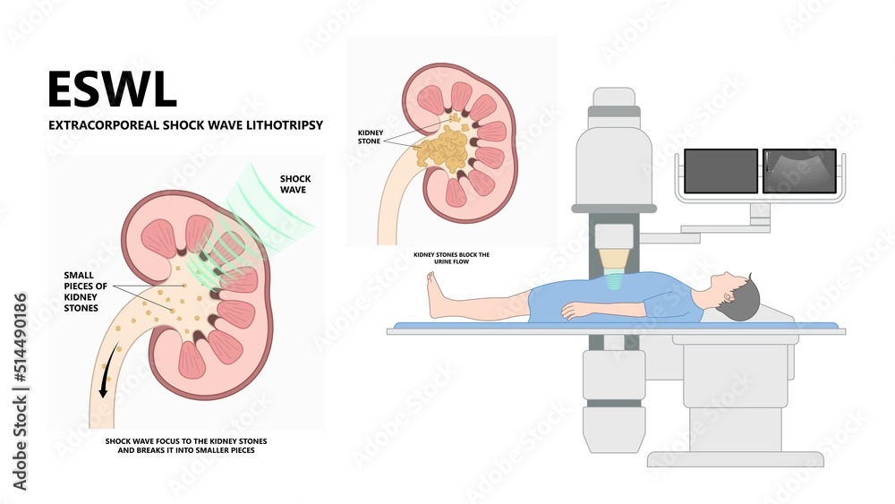 Stockvector Extracorporeal Shockwave Lithotripsy Eswl Kidney Stone