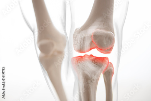 Medically accurate representation of an arthritic knee joint, knee meniscus, human leg