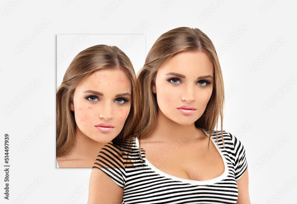 Acne,Skin concern,blemish-prone skin and acne, Rosacea,different types of acne Acne,Skin concern,blemish-prone skin and acne, Rosacea,different types of acne