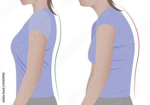 Illustration of a woman's back with a healthy spine and with scoliosis, a bent spine. Vector