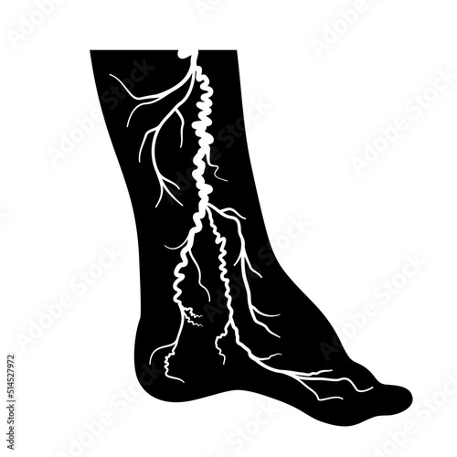 Varicose veins treatment