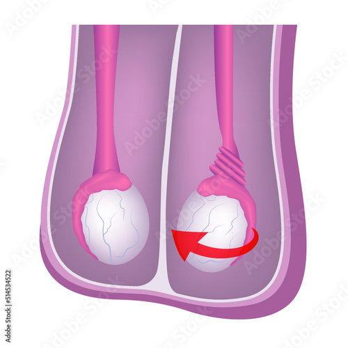 Testicular torsion. Diagram with the anatomy of the male genital organs. Medical poster. Vector illustration