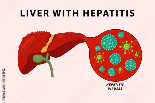 human liver hepatitis infection illustration