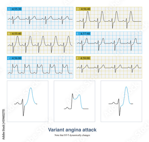 In this case, when the variant angina pectoris attacked, note the loss of the S wave of the QRS complex in Figure C, indicating grade III myocardial ischemia.