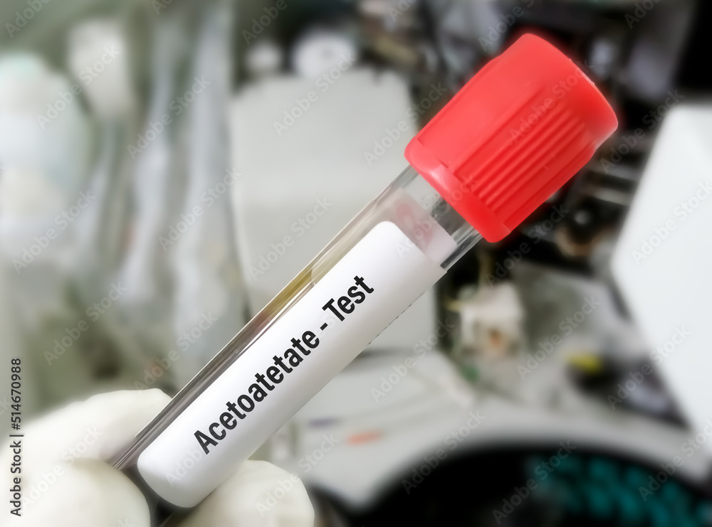 Blood sample for Acetoacetate test with laboratory background.