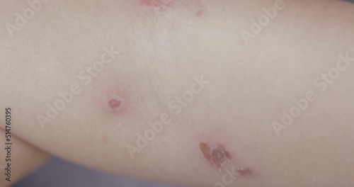 Bacterial skin infection on a child's arm, bacterial infection on the superficial skin