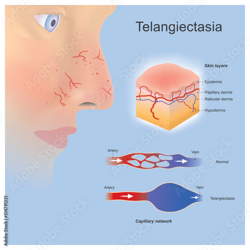 Telangiectasia. Problem tiny blood vessels widened or formed located near surface skin layers and you can clearly see..