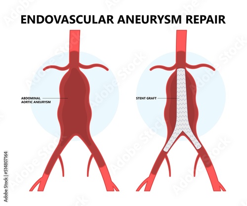 aortic arch pain with hernia blood vessel clots and stent dilated open renal vein kidney damage of Turner Marfan root disorder heart High stroke aorta bulge and attack chest of left graft