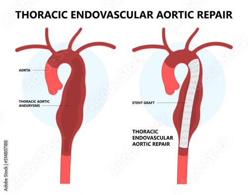 heart attack stroke disorder graft for aortic arch pain with hernia blood vessel clots and stent dilated open renal vein kidney damage of Turner Marfan root High bulge and chest of left aorta photo