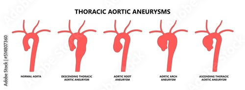 blood vessel stent dilated open renal vein kidney damage of Turner Marfan root disorder heart with High stroke aortic arch aorta bulge clots and attack chest of left graft hernia pain