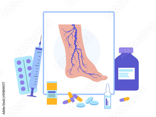 Varicose veins treatment