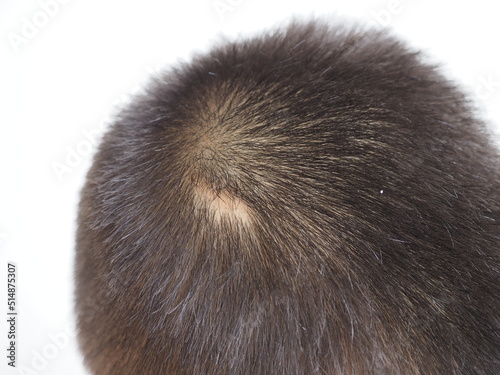Scar on skin head in kid boy use for fue hair transplant concept.  photo