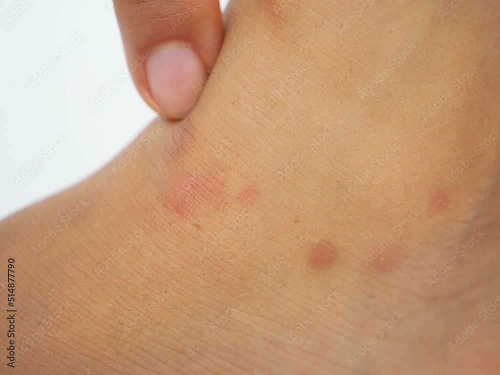 The leg with red spot caused by insect bite. closeup photo, blurred.