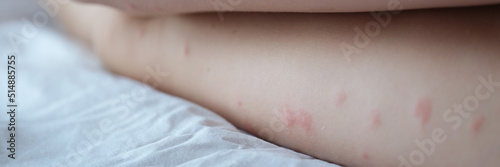 Red rash on the white skin of female legs  pimples